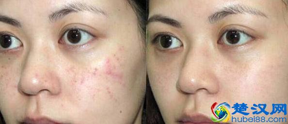 如何祛痘和痘印？教您最佳护理方法