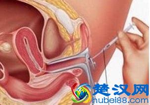 我靠！人工受孕的时候把精子取出来的方法有这些