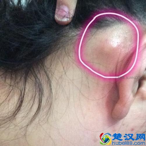 耳朵后面长了个疙瘩是怎么回事？医生说：要小心这几种情况！