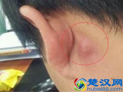 耳朵后面长了个疙瘩是怎么回事？医生说：要小心这几种情况！