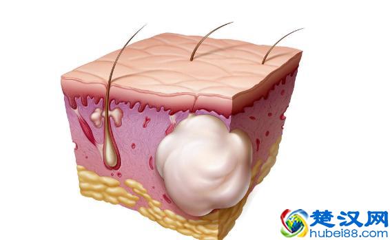耳朵后面长了个疙瘩是怎么回事？医生说：要小心这几种情况！
