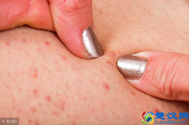 毛囊炎是细菌和真菌在捣乱！这四种人最易患毛囊炎