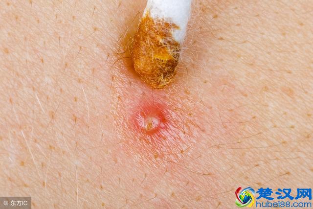 毛囊炎是细菌和真菌在捣乱！这四种人最易患毛囊炎