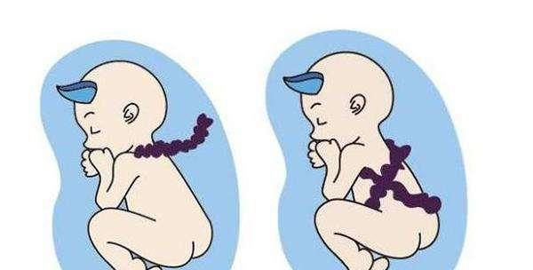 孕检查出脐带绕颈怎么办？别慌，孕妈妈知道这几点就够了