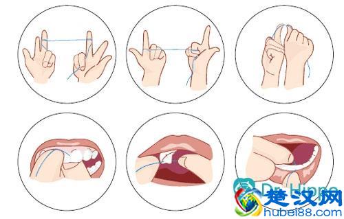 怎么去除牙菌斑？
