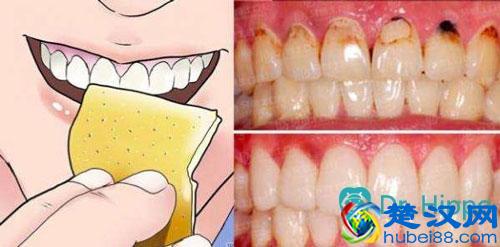 怎么去除牙菌斑？