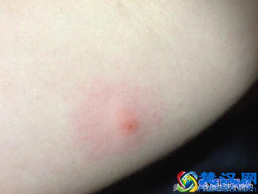 跳蚤咬的症状是什么？被跳蚤咬的症状图片