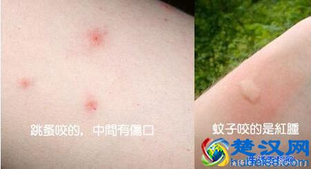 跳蚤咬的症状是什么？被跳蚤咬的症状图片
