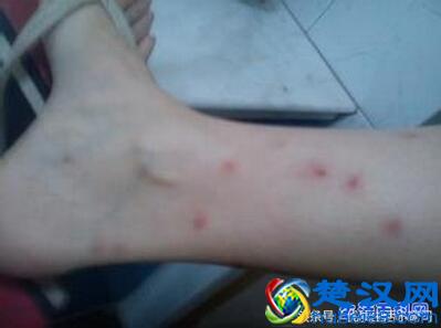 跳蚤咬的症状是什么？被跳蚤咬的症状图片