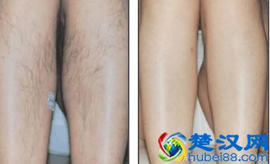 脱毛最持久又立马见效的方法，你还不试试？