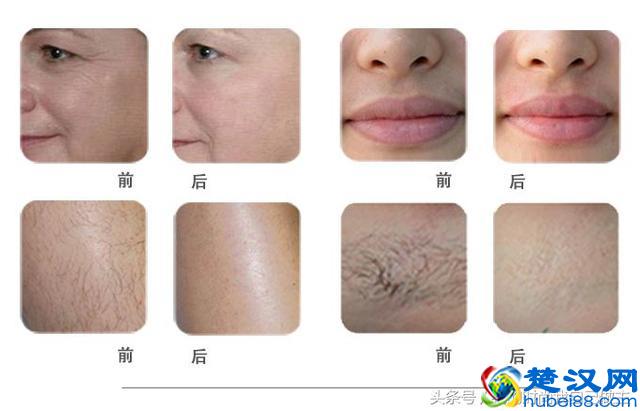 脱毛最持久又立马见效的方法，你还不试试？