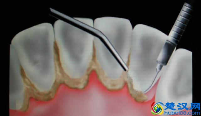 教你三个小方法轻松去除牙结石!