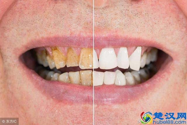 牙齿黄怎么办？这三个方法，不用洗牙就能美白牙齿