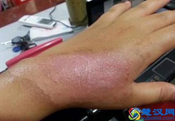 不小心烫伤怎么办？跟静静学一招，快速止疼不留疤痕，值得收藏