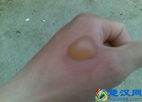 不小心烫伤怎么办？跟静静学一招，快速止疼不留疤痕，值得收藏