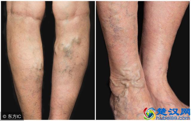 小腿静脉曲张竟藏着致命危险！哪种治疗方法能彻底去除静脉曲张？