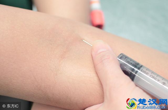 小腿静脉曲张竟藏着致命危险！哪种治疗方法能彻底去除静脉曲张？