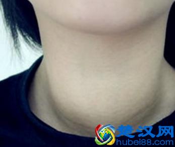 甲状腺炎有哪些症状?经常被忽视但又非常重要的病情