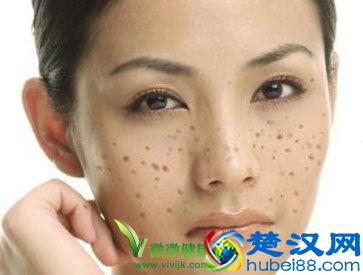 脸上长斑怎么调理 教你看穿色斑真相