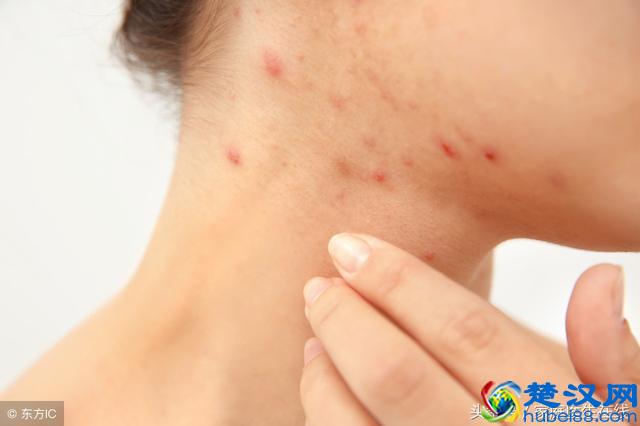 鱼油可助降血脂，但对这3类患者来说，还是少吃为妙