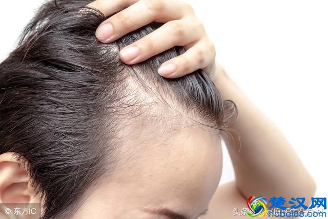 每天大把掉头发怎么办？平常注意这3点，再不用当“光头强”