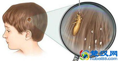 头上长虱子怎么办怎样简便消除？