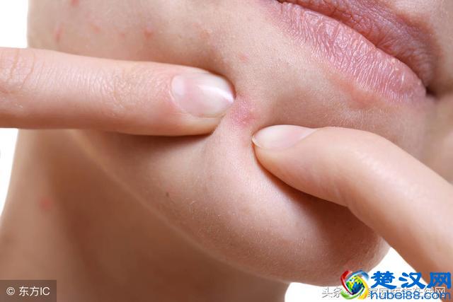 长痤疮是体内毒素太多？医生毫不掩饰：摆脱这6个坏习惯