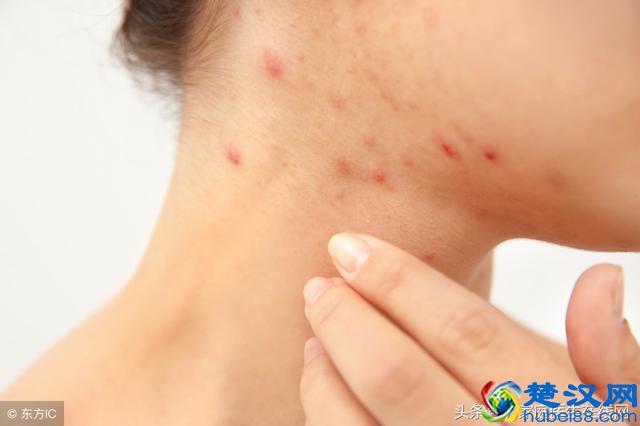 长痤疮是体内毒素太多？医生毫不掩饰：摆脱这6个坏习惯