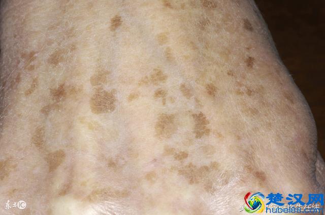 脸上长老年斑影响美观怎么办？不妨试试这四个方法