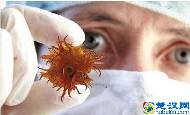 别把拉肚子不当回事，经常腹泻居然是这5种癌症的症状！