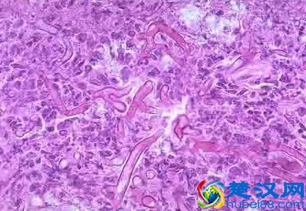 霉菌性阴道炎的具体症状是什么？霉菌性阴道炎真的能治好吗？