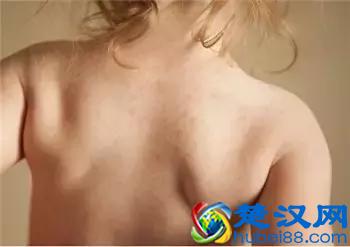 宝宝起痱子好难受？4步骤让宝宝和痱子说再见！