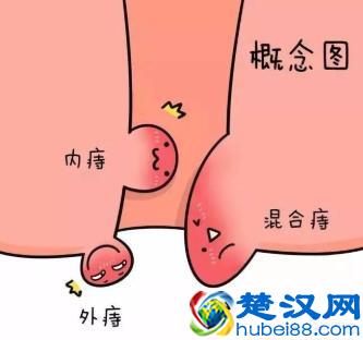 哪类人容易患上痔疮？怎么预防？