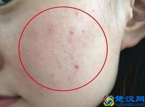 脸上有螨虫的人，要记住4个“天然除螨法”，把螨虫一点一点扼杀