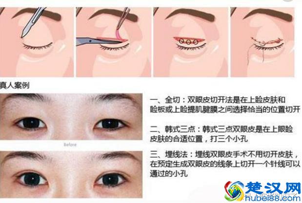 5种常见整形美容手术“风险排行榜”，还真不是价格的原因