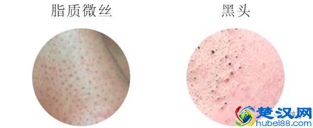 去除黑头的六种方法，到底哪种最有效？