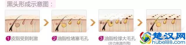 去除黑头的六种方法，到底哪种最有效？