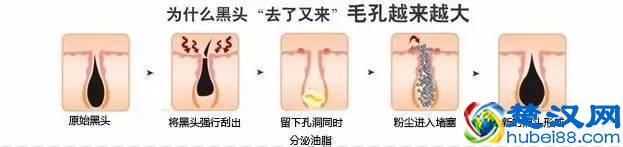 去除黑头的六种方法，到底哪种最有效？