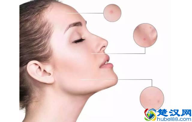 去除黑头的六种方法，到底哪种最有效？