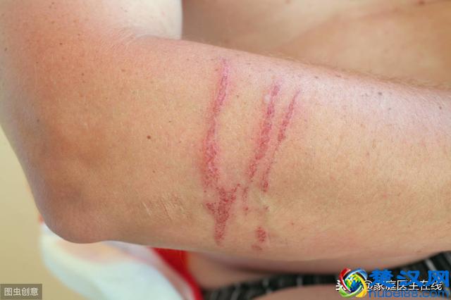 皮肤有疤痕怎么办？不要自卑：多吃这4种食物助于修复