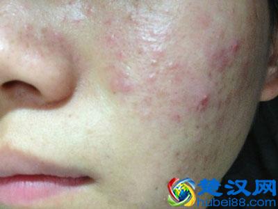 看中医推荐的内调祛痘方法