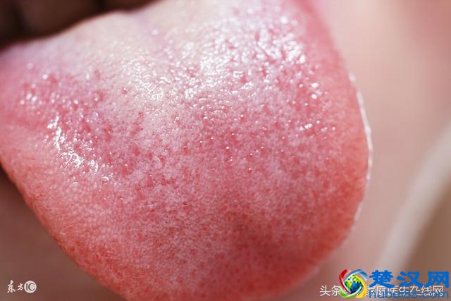 这是肝火旺的症状，你中招了吗？3招教你泻肝火