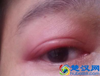 眼睛红血丝的真正原因，一共3个，你是哪一个