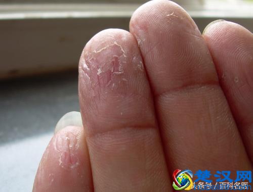 一换季手就脱皮是怎么回事儿？有什么方法可以根治吗？送你几个小偏方！
