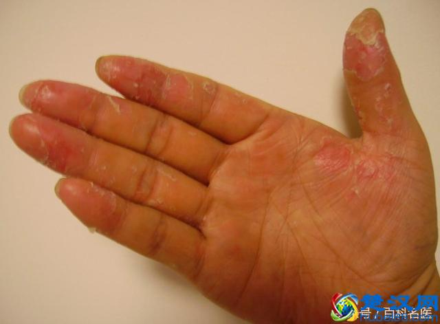 一换季手就脱皮是怎么回事儿？有什么方法可以根治吗？送你几个小偏方！