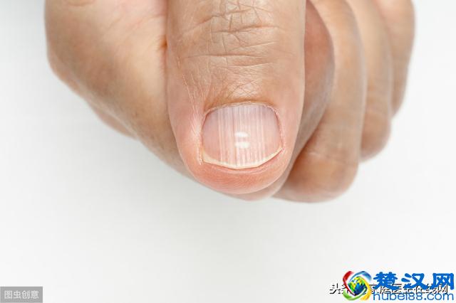 指甲有竖纹是怎么回事？总结6个原因，都要重视