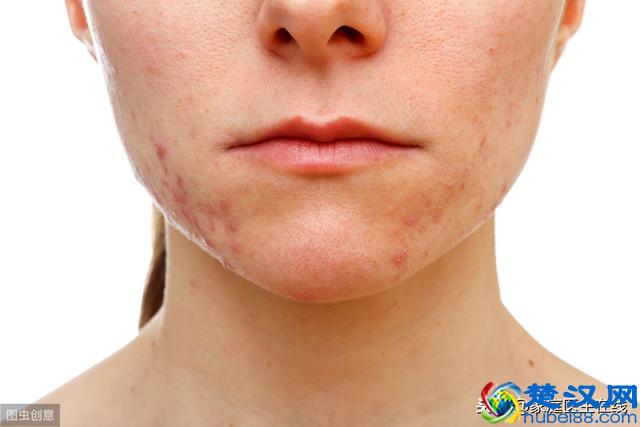 下巴长痘的人，这5个原因，请自觉排查！别一拖再拖