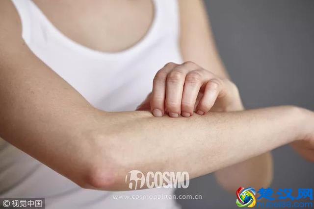 每年夏天都紫外线过敏的我今年好了！秘诀在这