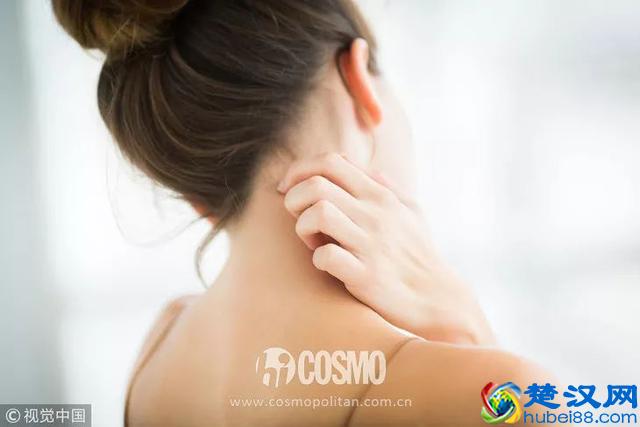 每年夏天都紫外线过敏的我今年好了！秘诀在这