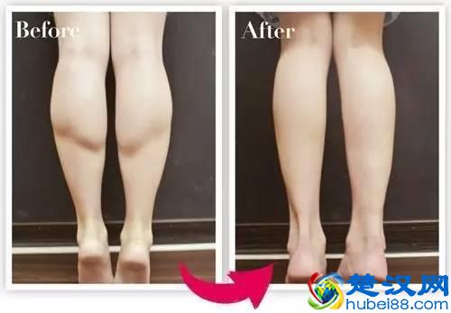 肌肉型小腿顽强难减？试试这个方法！